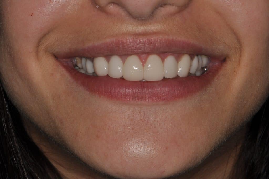 dental implant after