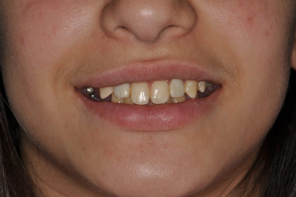 dental implant before